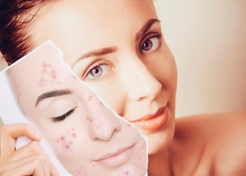 Eliminar las marcas del acné es posible y te decimos cómo